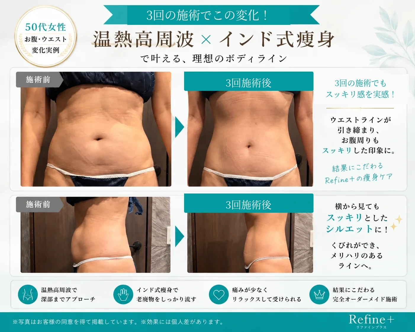 温熱高周波とインド式痩身 3回施術例
